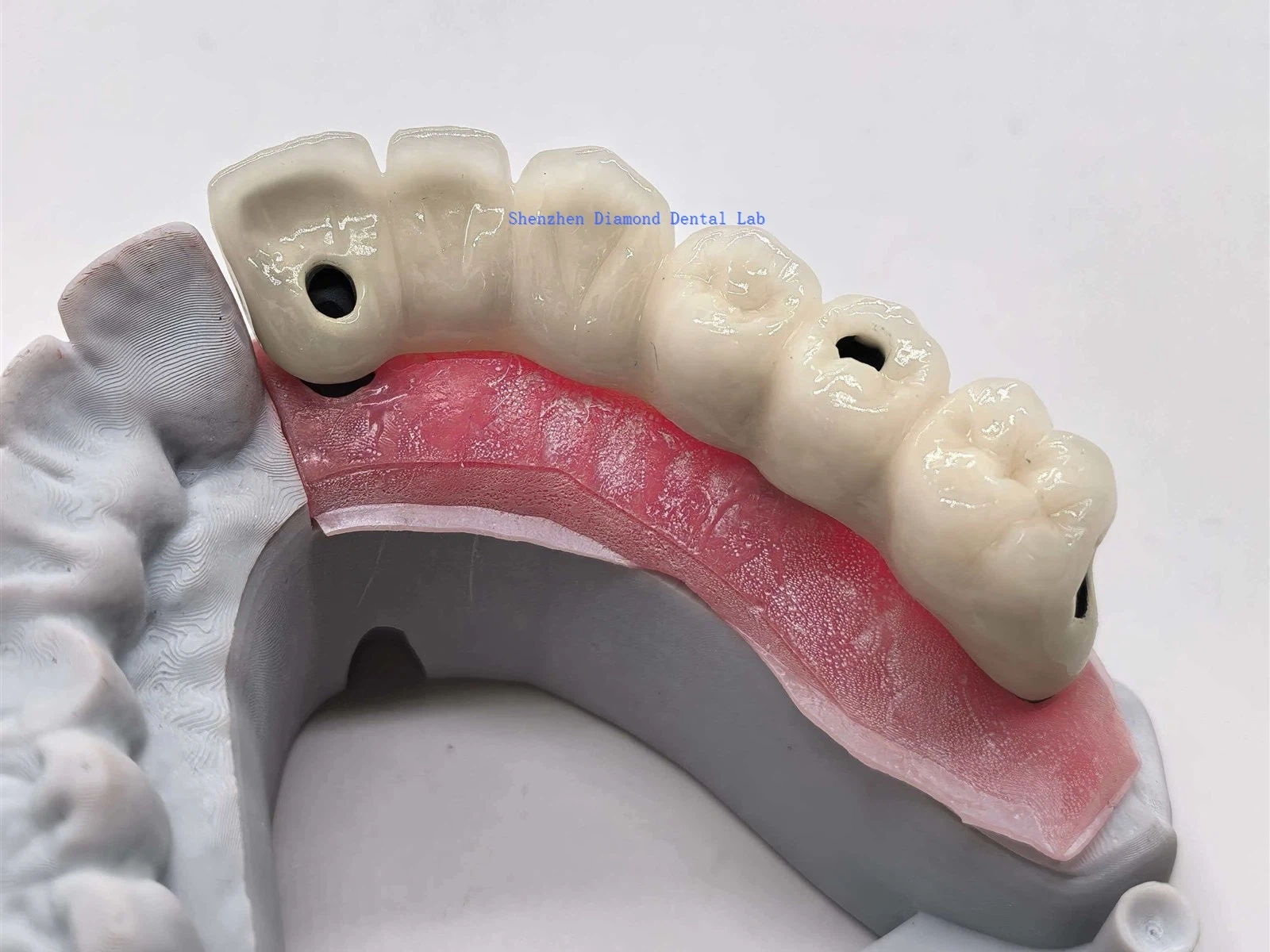 Couronnes fonctionnelles en zircone pour implants