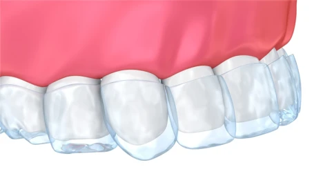 Protège-dents de blanchiment des dents personnalisé